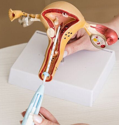 Intrauterine Insemination